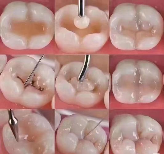 杭州补牙方法有哪些？哪种材质更适合自己？-图2