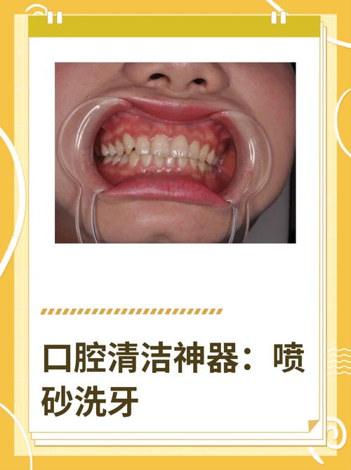 口腔喷砂方法如何操作？步骤与注意事项有哪些？-图1