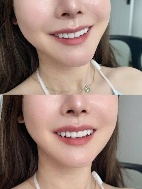 牙齿贴面方法怎么选？哪种更适合自己？-图3