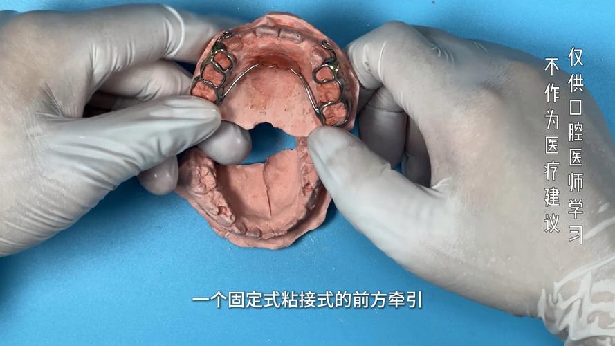固定牙齿方法-图3
