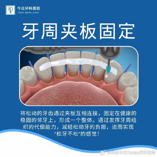 固定牙齿方法-图2