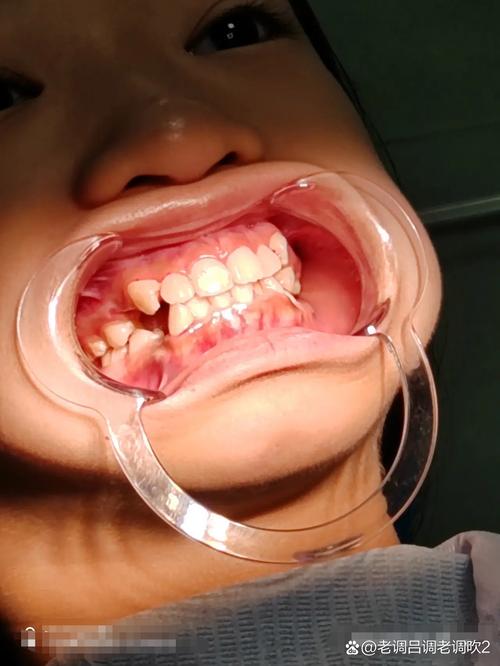 正畸可以只拔一颗牙吗-图3