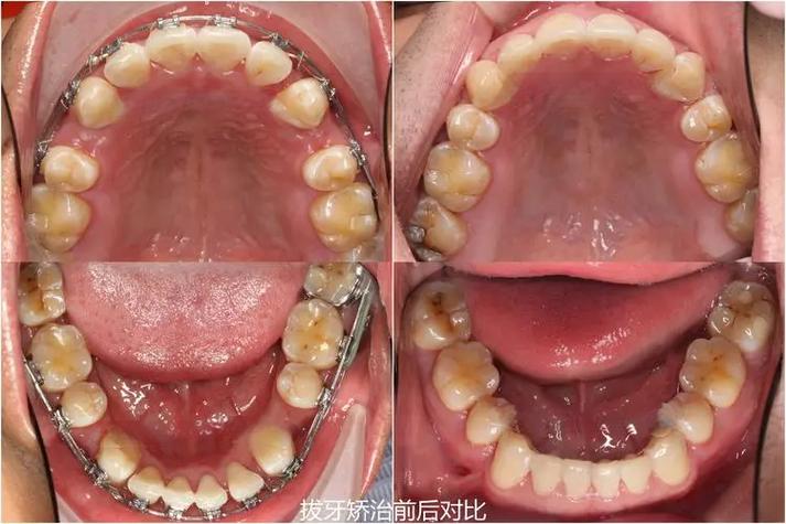 正畸拔牙一般拔哪些牙-图2