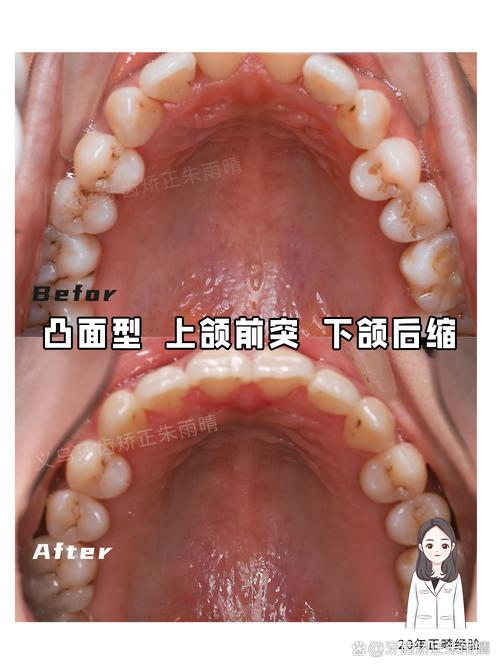 牙槽骨突出正畸矫正有用吗？-图3