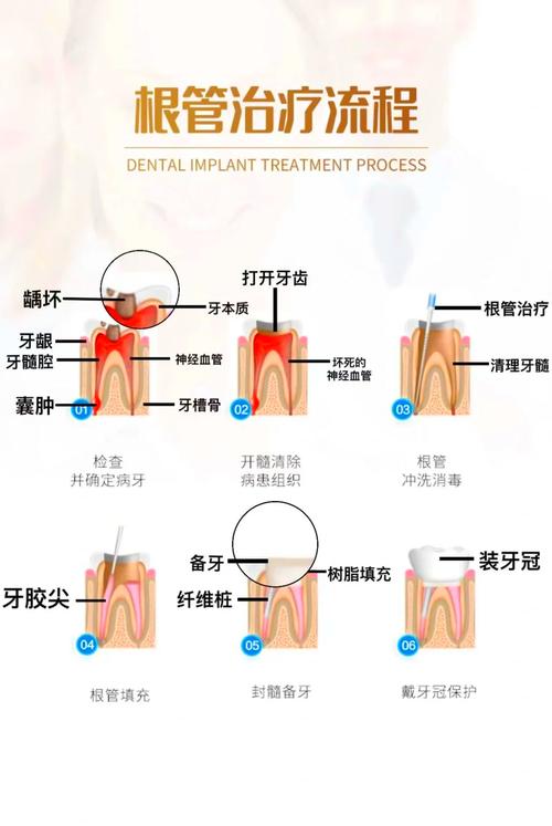 牙管治疗方法-图1