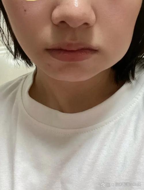 种牙拆线后为何还肿？是正常现象吗？-图2