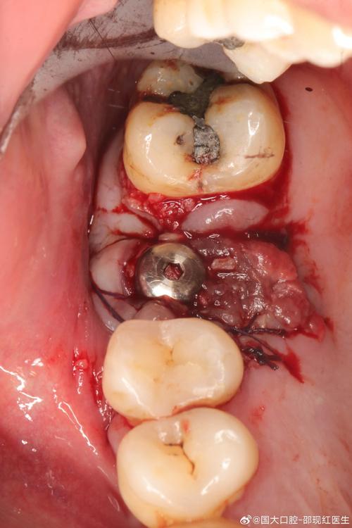 种牙拆线后为何还肿？是正常现象吗？-图3