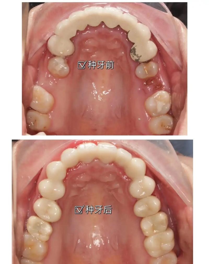 没牙龈能种牙吗-图2