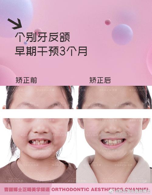 小孩正畸牙齿的最佳矫正年龄是什么时候？-图2