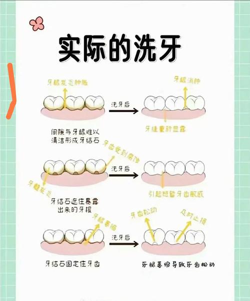 快速洁牙方法-图3