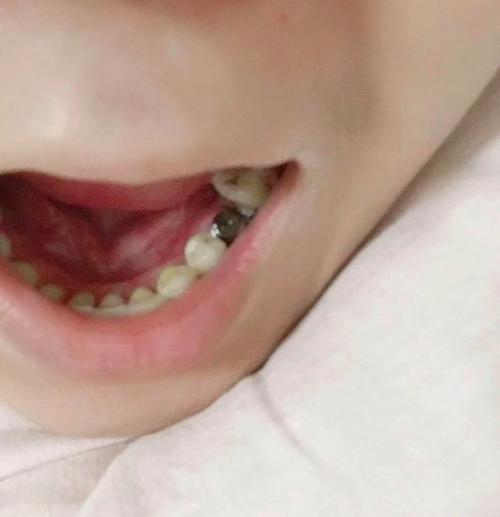 有小孩种牙的吗-图2 有小孩种牙的吗-图2