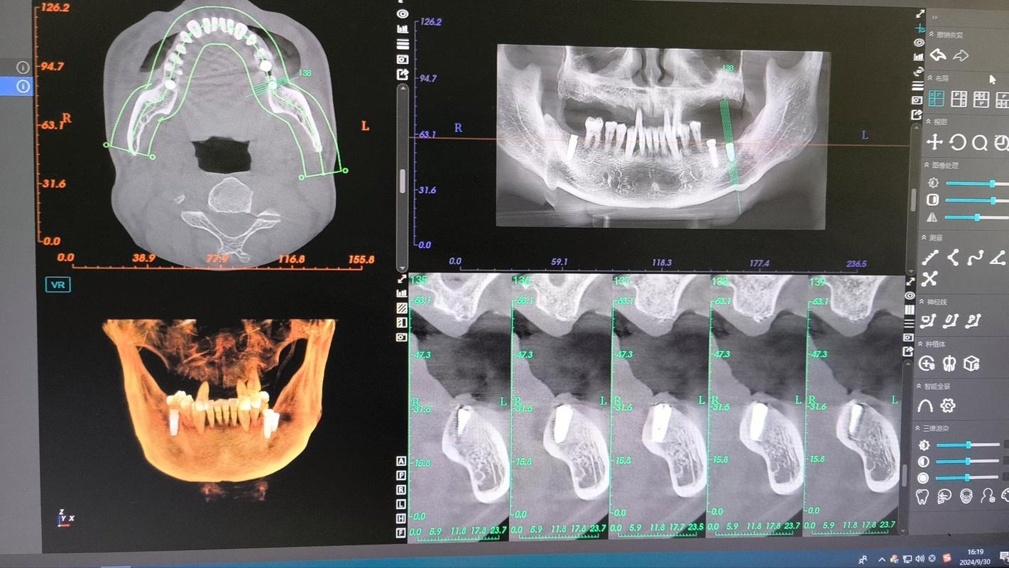 种牙怎么做ct-图1