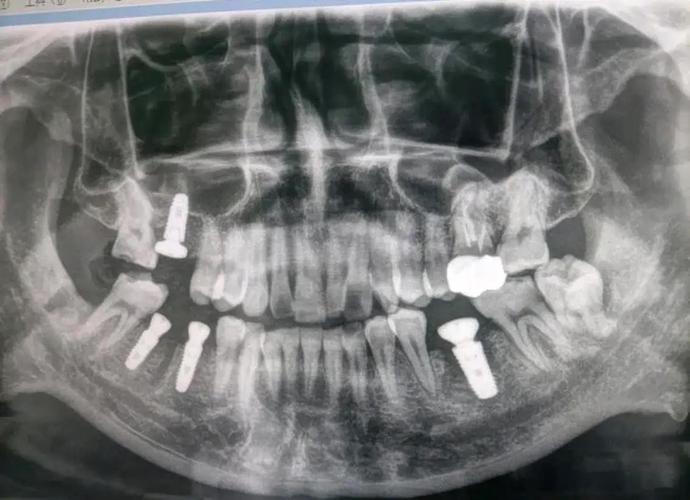 种牙怎么做ct-图3