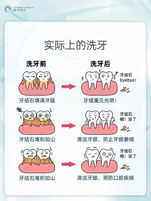 儿童洁牙方法-图1