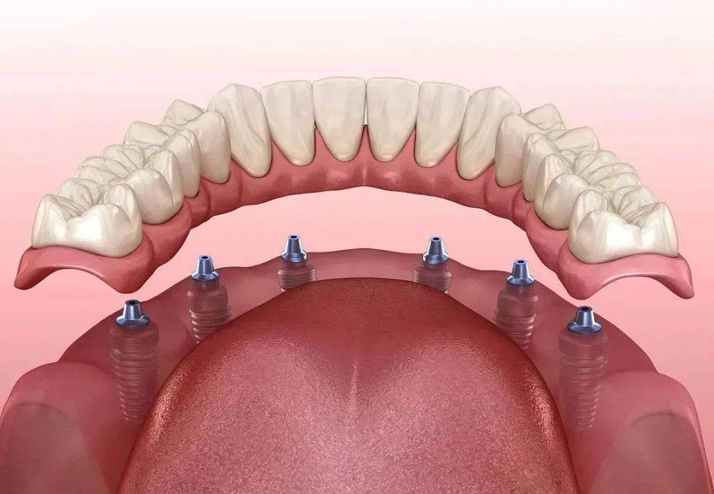半口牙即种即用-图2