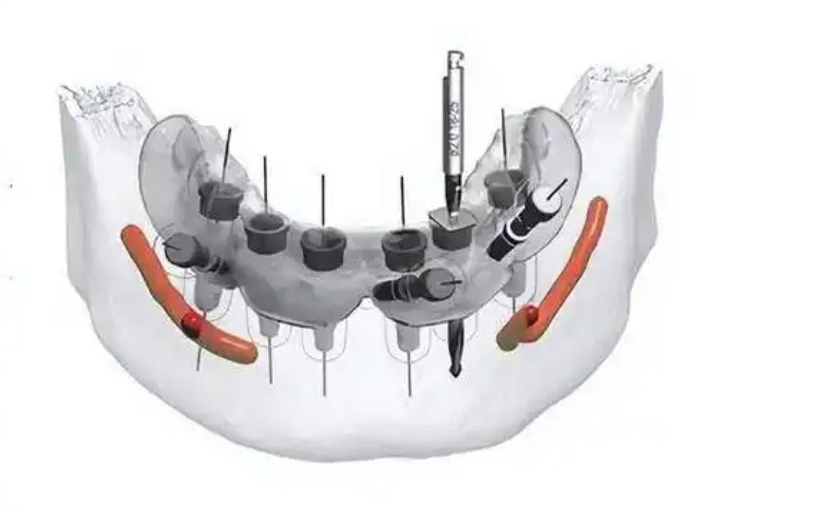 数字化导航种牙，精准高效有何优势？-图2
