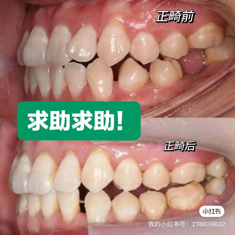 牙齿咬合错位必须正畸-图3