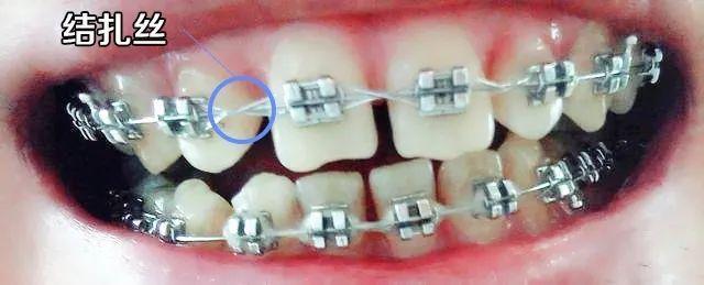 正畸八字结扎方法图解-图3
