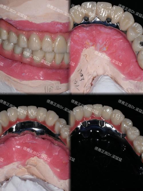 牙齿间距大能种牙吗？修复效果会受影响吗？-图3