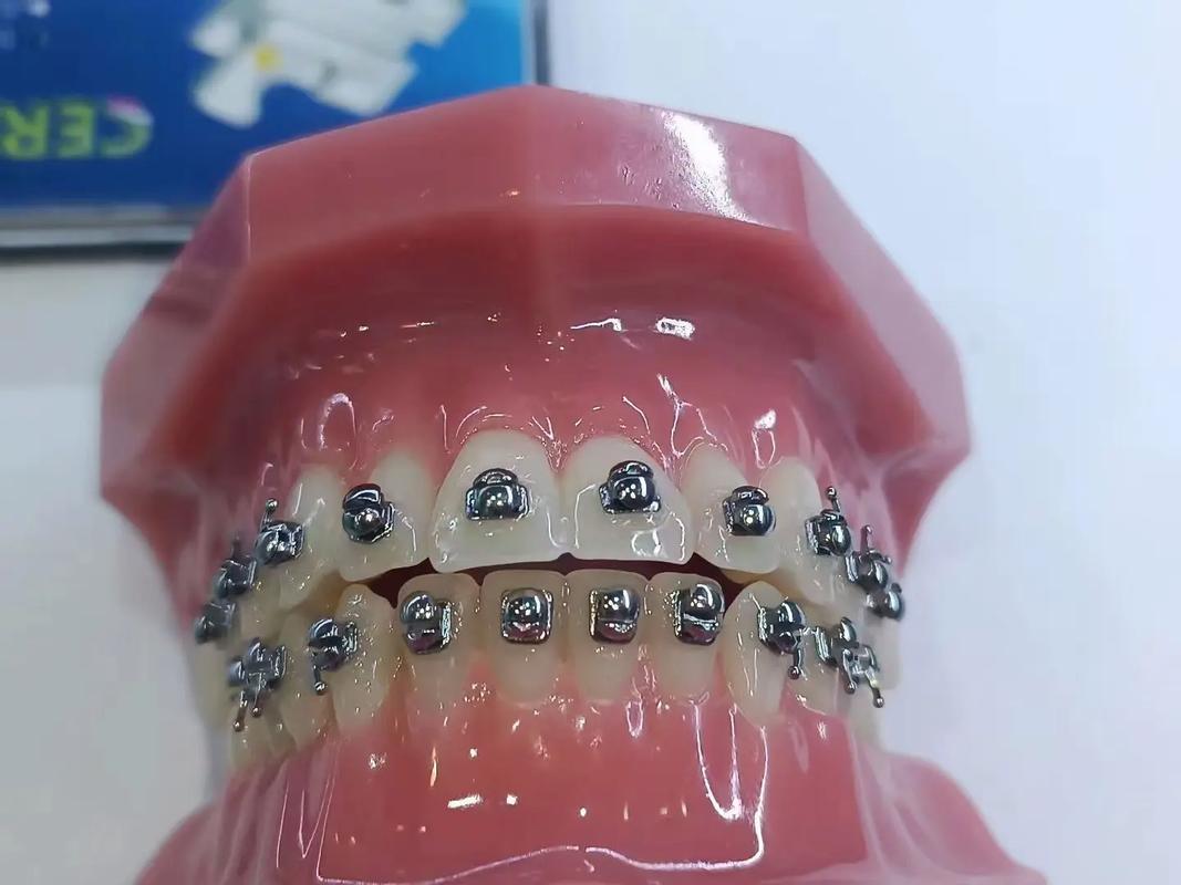 正畸牙齿自锁托槽好吗-图2