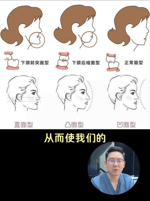 牙齿正畸对脸型的影响-图3