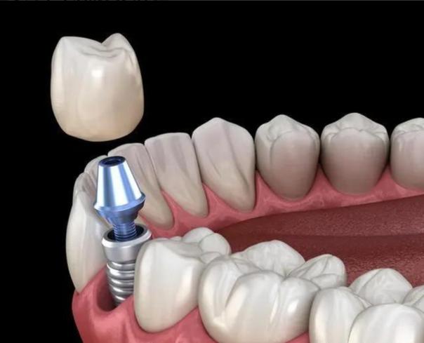 半年后种牙九院-图3