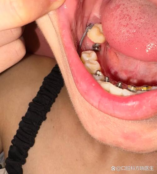 种牙后邻牙疼痛为何会发生？-图1