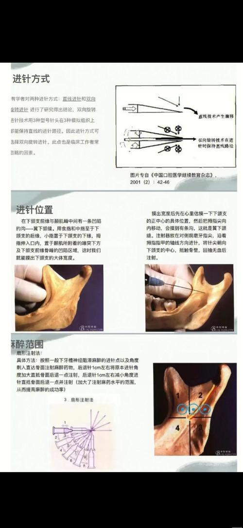 口腔麻醉方法有哪些？如何选择适合的治疗方式？-图1
