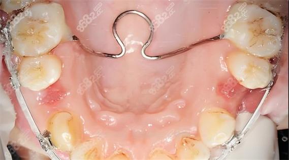正畸TPA是什么？它在矫正中有什么作用？-图2