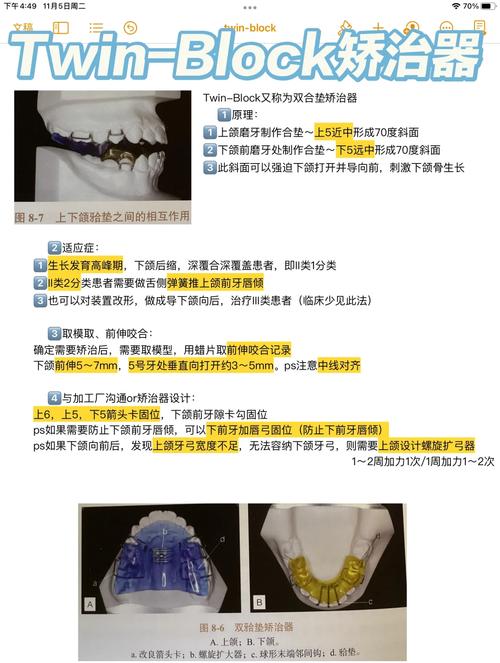 正畸TPA是什么？它在矫正中有什么作用？-图1