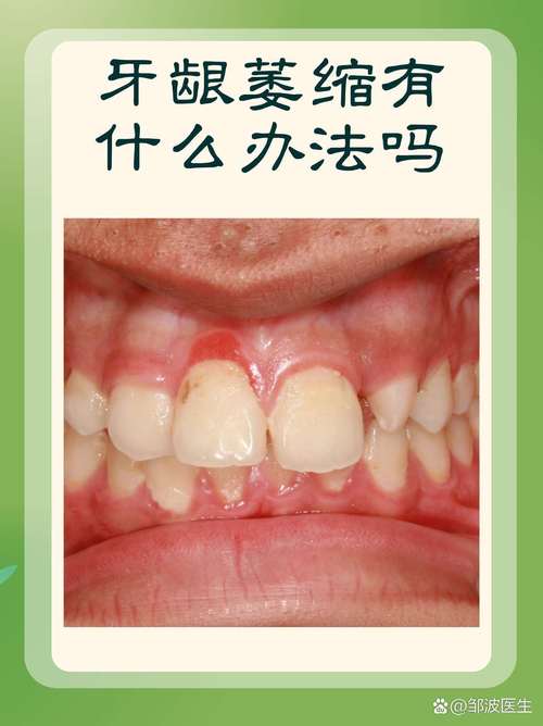 正畸会导致牙龈萎缩吗-图1