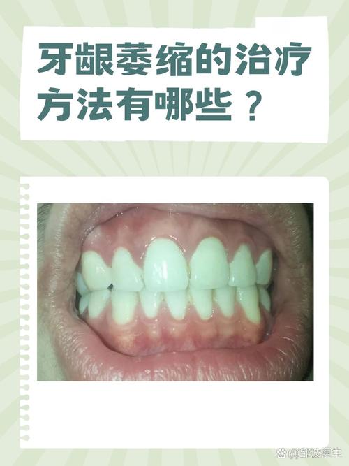 正畸会导致牙龈萎缩吗-图2