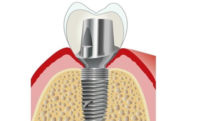 德国贝格种殖牙-图1