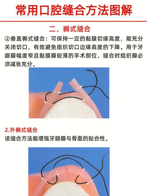 口腔缝合常用方法有哪些?不同伤口如何选择技巧?-图1 口腔缝合常用方法有哪些?不同伤口如何选择技巧?-图1