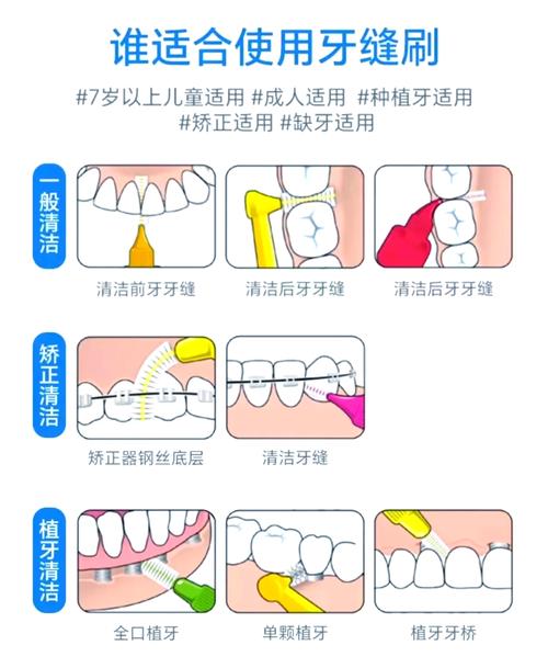 牙缝处理方法-图2