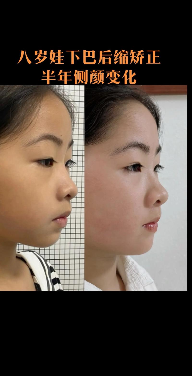 牙齿正畸前后对比图片，究竟藏着哪些肉眼可见的惊人变化？-图3