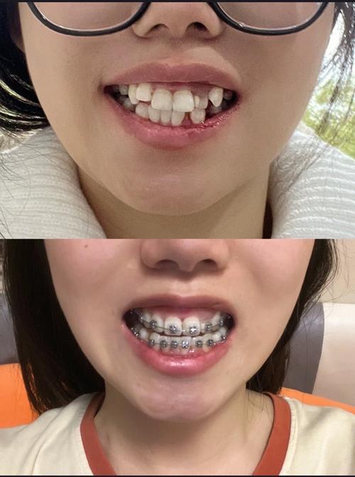 牙齿正畸前后对比图片，究竟藏着哪些肉眼可见的惊人变化？-图1