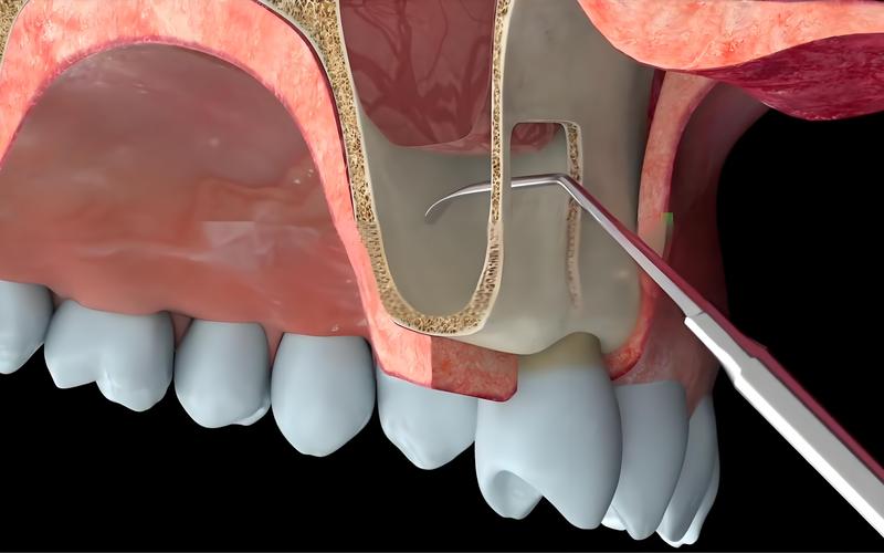 种牙上颌窦提拉是什么？技术原理、效果及安全风险如何？-图3