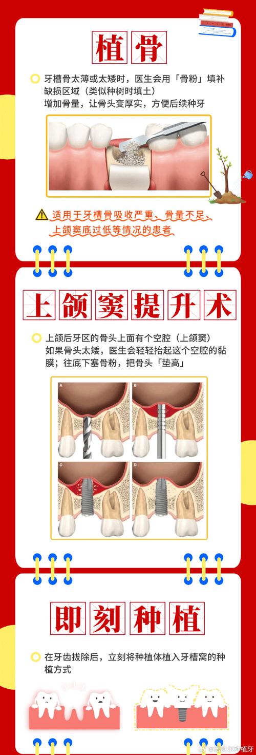 种牙都得骨植吗？30字左右疑问标题-图3
