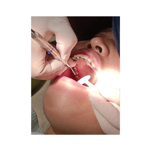 正畸一个月复诊一次-图3