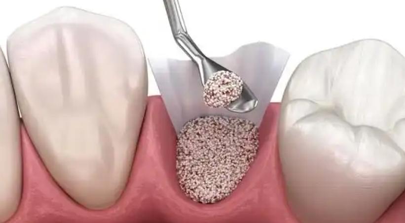 种牙为何必须用生物膜？-图3