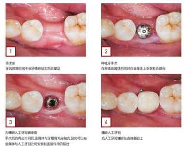 微创种牙哪里找？靠谱机构和渠道有哪些？-图2
