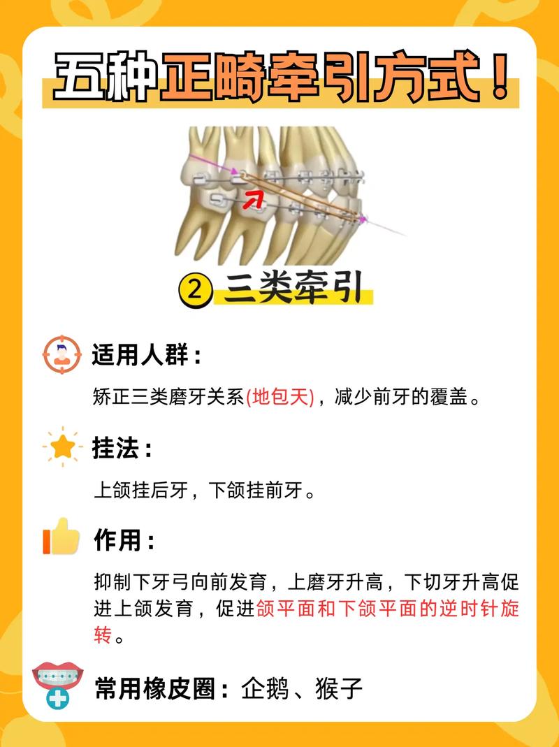 正畸橡皮圈三角挂法是什么？如何正确操作？-图1