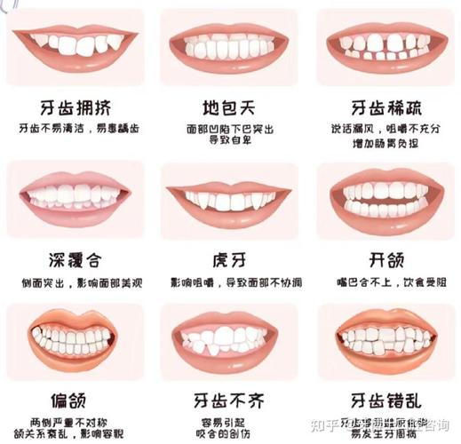 正畸一类二类面型有何区别？如何判断与选择？-图1