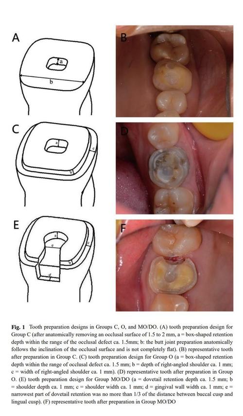 根管预备方法有哪些？不同技术的操作要点与效果如何？-图2