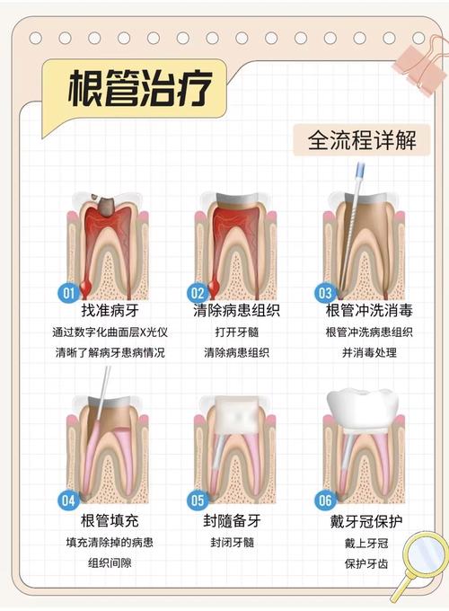 根管预备方法有哪些？不同技术的操作要点与效果如何？-图3