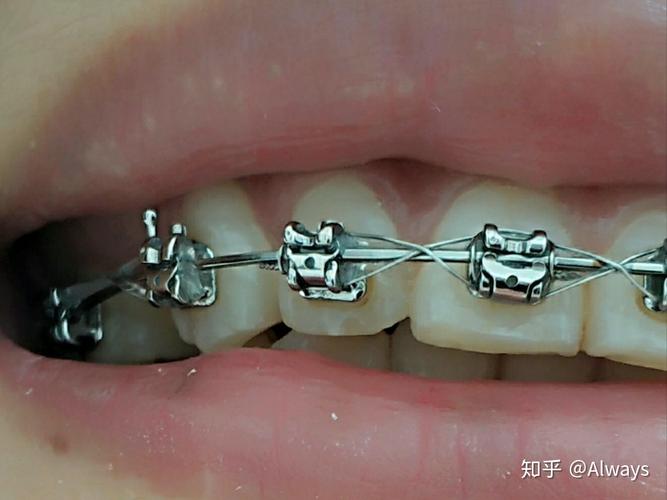 正畸锁丝是干什么的?揭秘它在牙齿矫正中的关键作用-图3 正畸锁丝是干什么的?揭秘它在牙齿矫正中的关键作用-图3