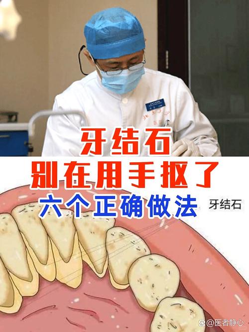 如何有效去除牙石？不同方法的效果和安全性如何？-图1