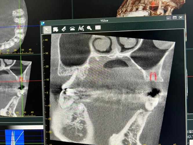 种牙离上额窦近，会有风险吗？需注意什么？-图1