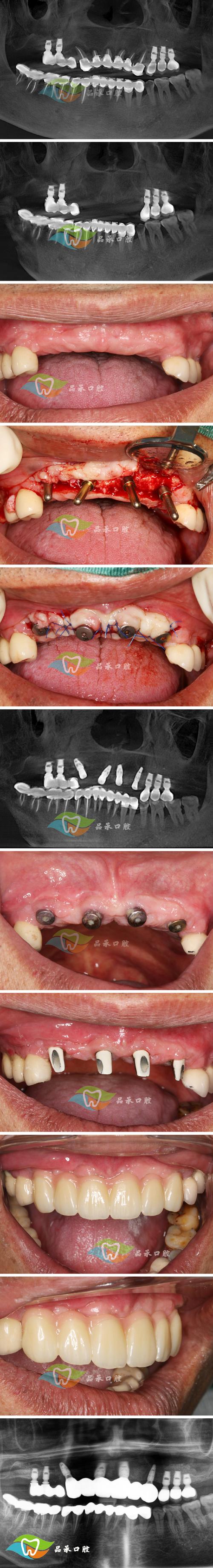 骨头素真的能用来种牙吗？-图2